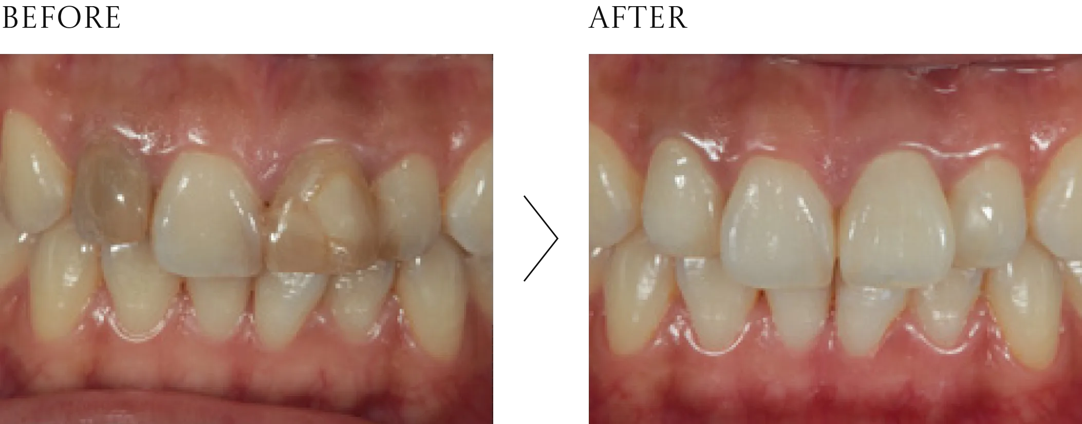 前歯の被せ物（ジルコニア）の症例