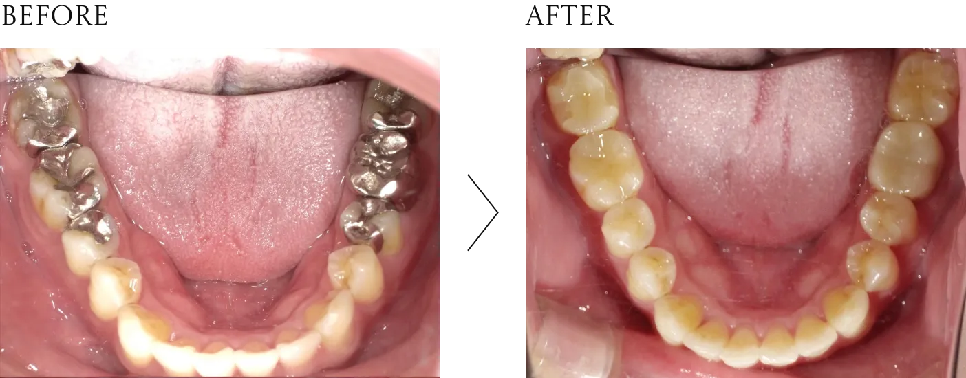 奥歯被せ物（ジルコニア）の症例