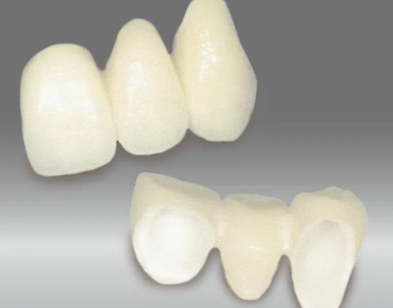 セラミックブリッジ